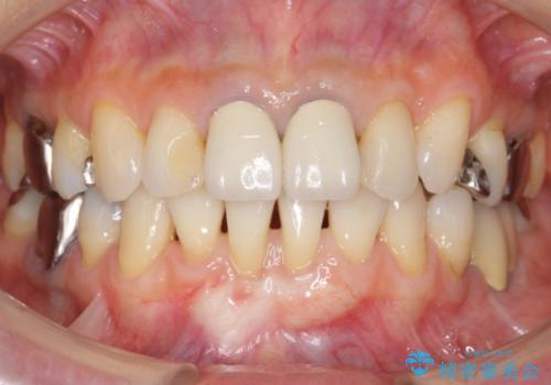 不適合なつめ物による歯ぐきの違和感　40代女性の治療後
