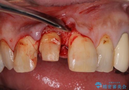 前歯がとれた　残った小さい歯を引っ張り出して保存するの治療中