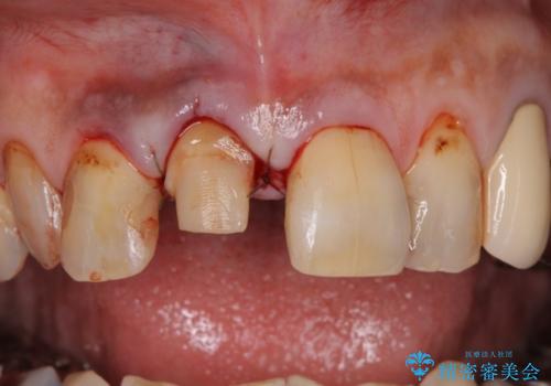 前歯がとれた　残った小さい歯を引っ張り出して保存するの治療前
