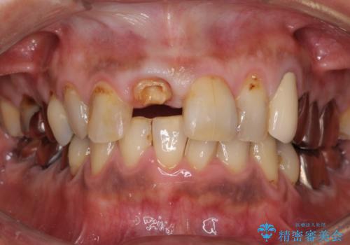 前歯がとれた　残った小さい歯を引っ張り出して保存するの症例 治療前