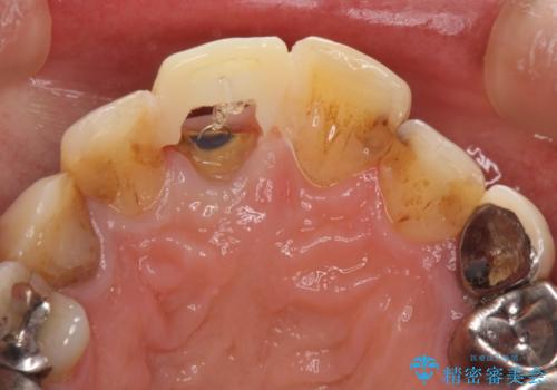 前歯がとれた　残った小さい歯を引っ張り出して保存するの治療後