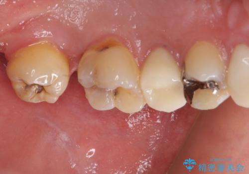 左上奥歯の虫歯　白い詰め物セラミックインレーの治療前