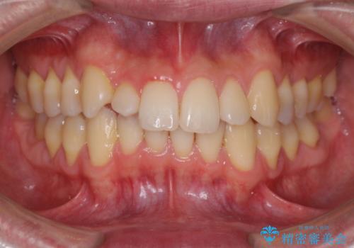 矮小歯のオールセラミッククラウンによる審美的改善の治療前