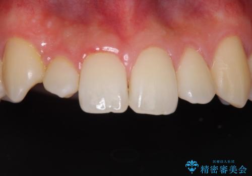 矮小歯のオールセラミッククラウンによる審美的改善の治療前