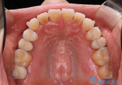 歯を抜かずに八重歯をきれいに!　インビザラインによる全顎矯正治療の治療中
