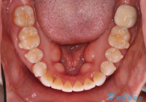 歯を抜かずに八重歯をきれいに!　インビザラインによる全顎矯正治療の治療中