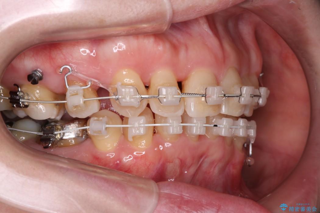 重度の不正咬合 Cl.Ⅱ div.2 を表のワイヤー矯正で綺麗に!｜（医）精密