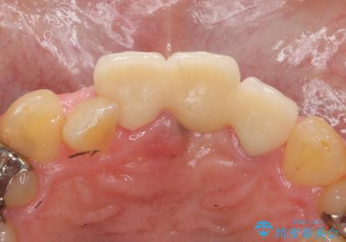 [歯牙破折]  歯槽堤保存術を応用した上顎前歯ブリッジの治療後