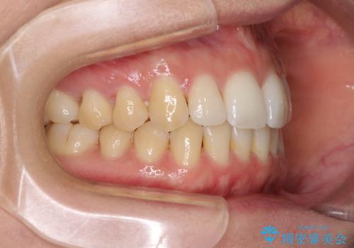 前歯のでこぼこを改善　インビザラインによる矯正治療の治療中
