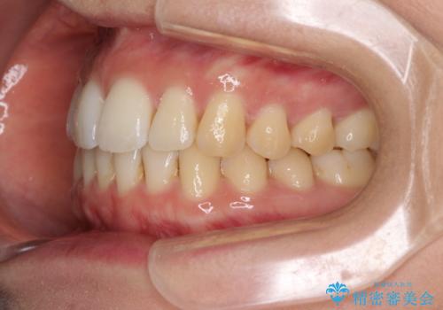 前歯のでこぼこを改善　インビザラインによる矯正治療の治療中