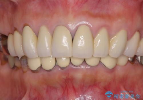 金属の色が見える前歯をオールセラミックにの治療前