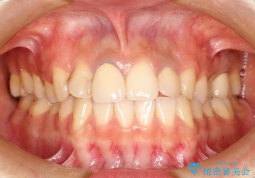 前歯のセラミック修復　根管治療・歯周外科も行うの治療前