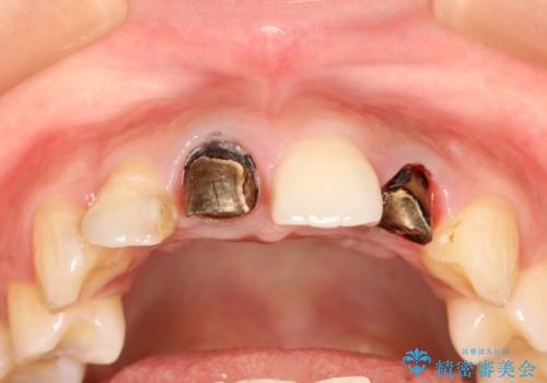 前歯のセラミック修復　根管治療・歯周外科も行う