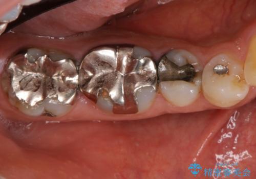 歯周外科を併用したセラミックインレー修復の症例 治療前