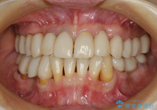 どんなに歯を磨いても治らない　重度歯周病患者の治療の治療中