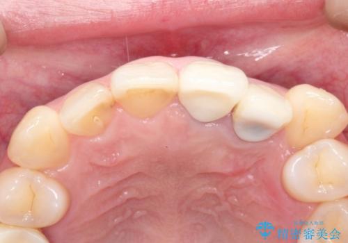 上の前歯に違和感がある　根管治療からの再治療の治療後