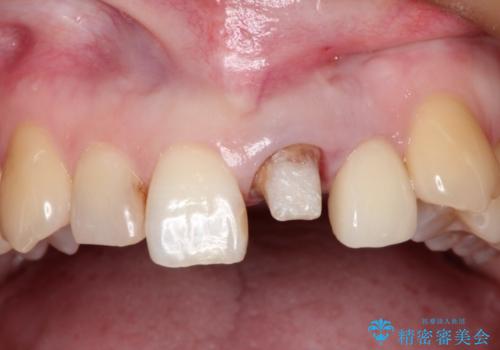 上の前歯に違和感がある　根管治療からの再治療の治療中