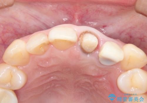 上の前歯に違和感がある　根管治療からの再治療の治療中