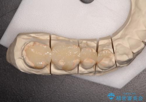 歯周外科を併用したセラミックインレー修復の治療後