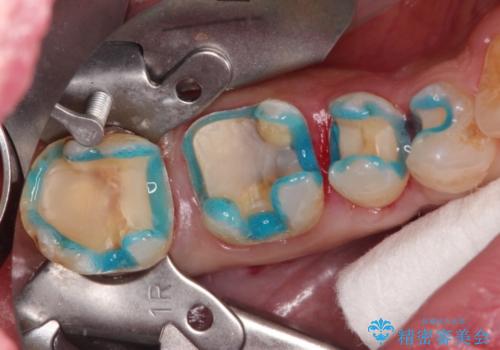 歯周外科を併用したセラミックインレー修復
