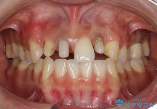 前歯のセラミック修復　根管治療・歯周外科も行うの治療中
