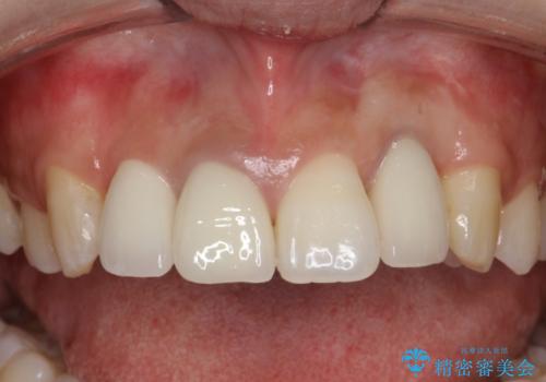 前歯のセラミック修復　根管治療・歯周外科も行うの治療後