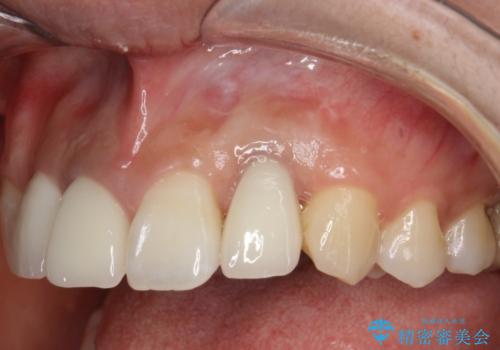 前歯のセラミック修復　根管治療・歯周外科も行うの治療後