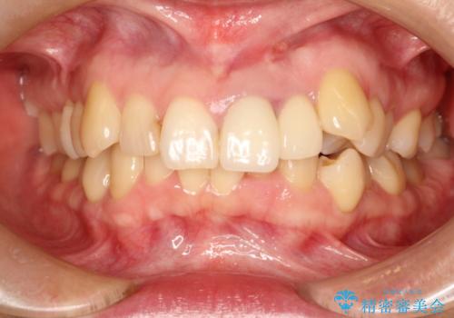 上の前歯に違和感がある　根管治療からの再治療の治療前