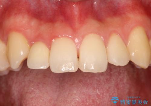 矮小歯のオールセラミッククラウンによる審美的改善の治療後