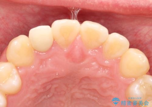 矮小歯のオールセラミッククラウンによる審美的改善の治療後