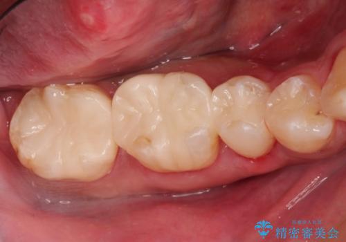 歯周外科を併用したセラミックインレー修復の症例 治療後