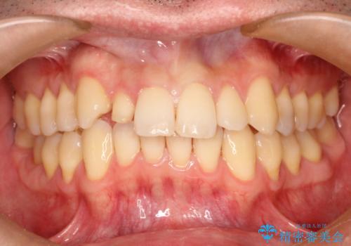 矮小歯のオールセラミッククラウンによる審美的改善の治療中
