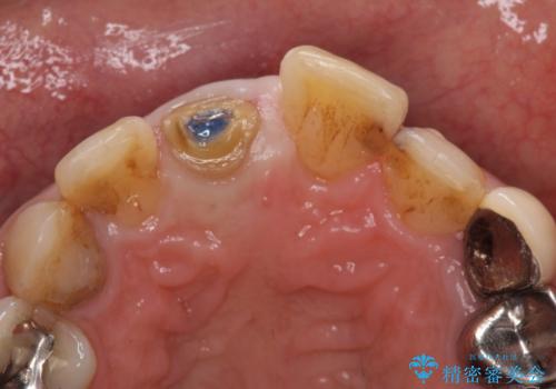 前歯がとれた　残った小さい歯を引っ張り出して保存するの治療中