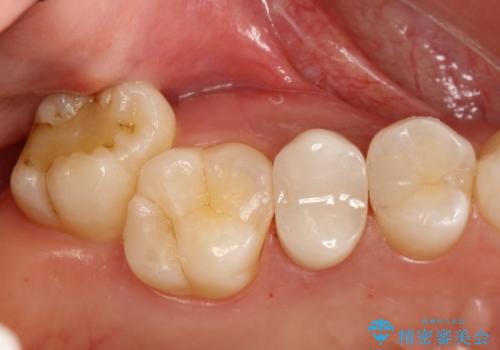 神経に達する深い虫歯　根管治療とかぶせもの治療の症例 治療後