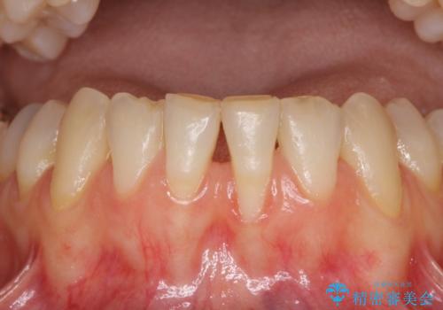 前歯の歯肉退縮　歯肉移植による根面被覆の治療前