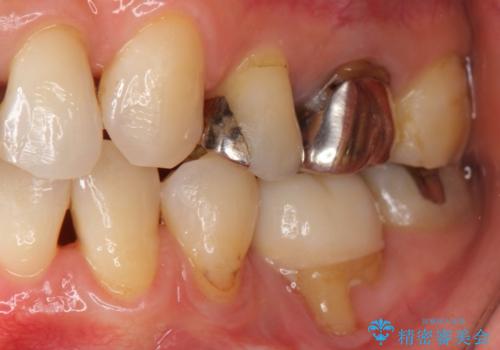 不適合なつめ物による歯ぐきの違和感　40代女性の治療中