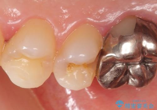 セラミックインレー　被せ物が取れた歯の治療の治療前