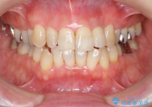 前歯の色変化　セラミッククラウンによる審美性の改善の治療後