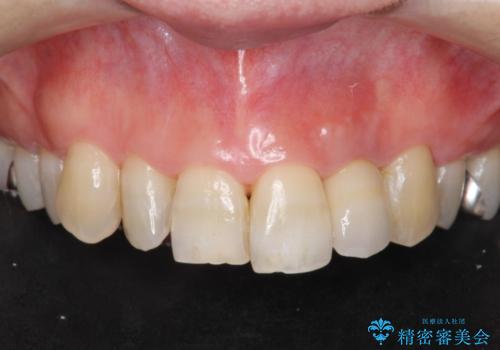 前歯の色変化　セラミッククラウンによる審美性の改善の治療後