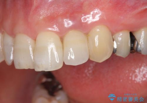 前歯の色変化　セラミッククラウンによる審美性の改善の症例 治療後