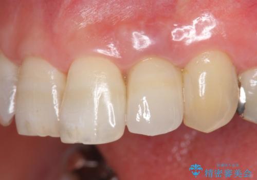 前歯の色変化　セラミッククラウンによる審美性の改善