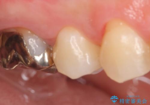 セラミックインレー　被せ物が取れた歯の治療の治療前