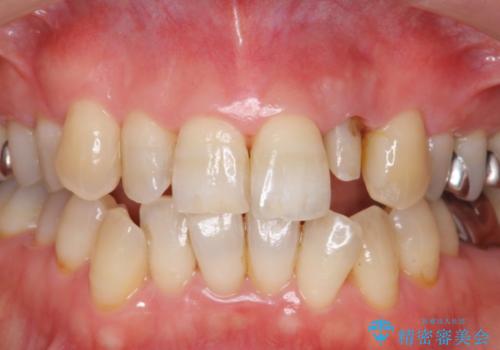 前歯の色変化　セラミッククラウンによる審美性の改善の治療中