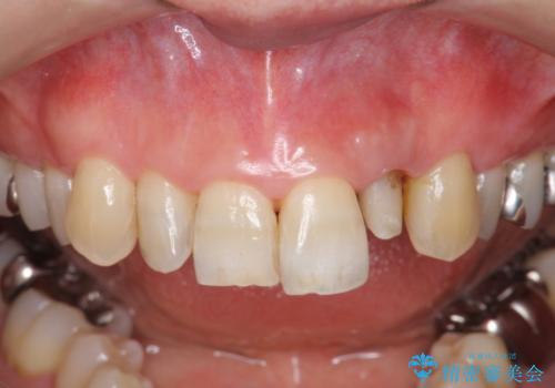 前歯の色変化　セラミッククラウンによる審美性の改善の治療中