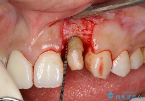 前歯のセラミック修復　根管治療・歯周外科も行うの治療中
