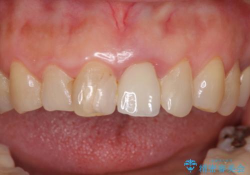 歯茎の腫れた前歯を綺麗にしたい　部分矯正を用いたセラミック治療の症例 治療前