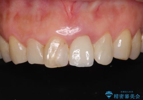 歯茎の腫れた前歯を綺麗にしたい　部分矯正を用いたセラミック治療の治療前
