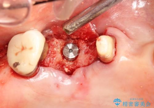 上の奥歯が保存不可能に→サイナスソケットリフトで薄い骨にも対応