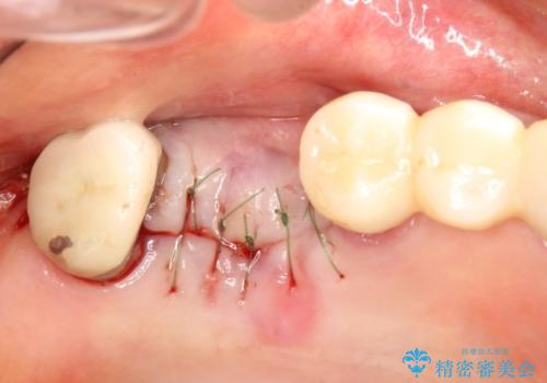 上の奥歯が保存不可能に→サイナスソケットリフトで薄い骨にも対応の治療中
