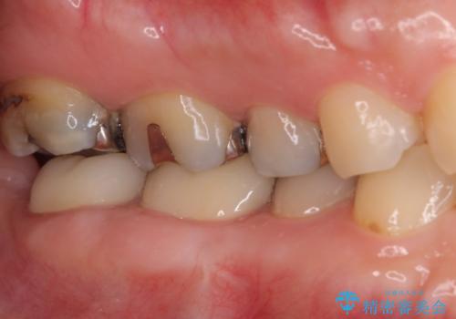 歯医者嫌いで歯がボロボロに 外科処置を用いた抜かない補綴治療の症例 治療後